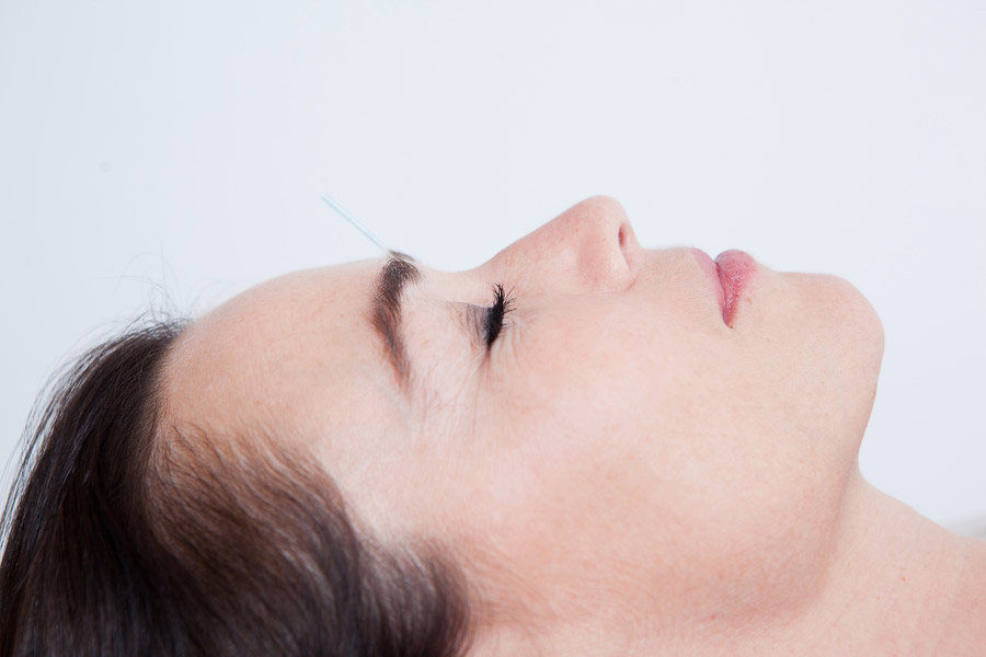 Stimulation of the acupuncture points